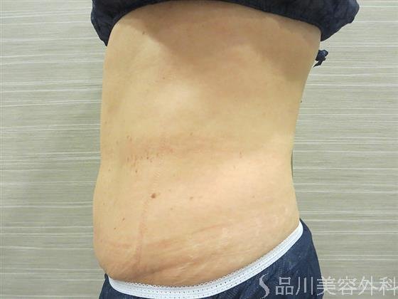 症例NO.20563のAFTER写真