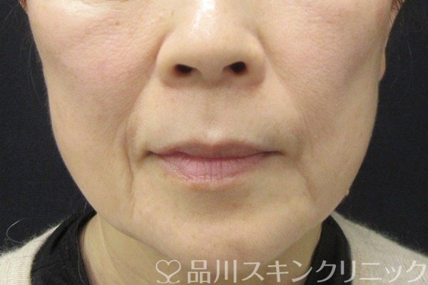 症例NO.67902のBEFORE写真
