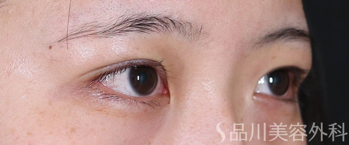 症例NO.71075のAFTER写真