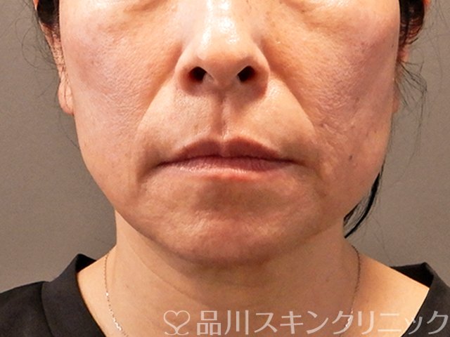 症例NO.70858のBEFORE写真