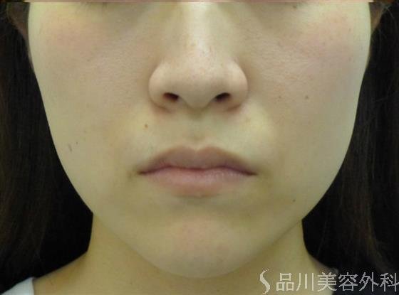 症例NO.50115のAFTER写真