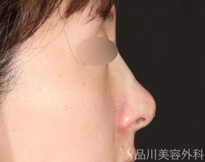 症例NO.72067のAFTER写真