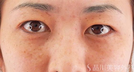 症例NO.59093のAFTER写真