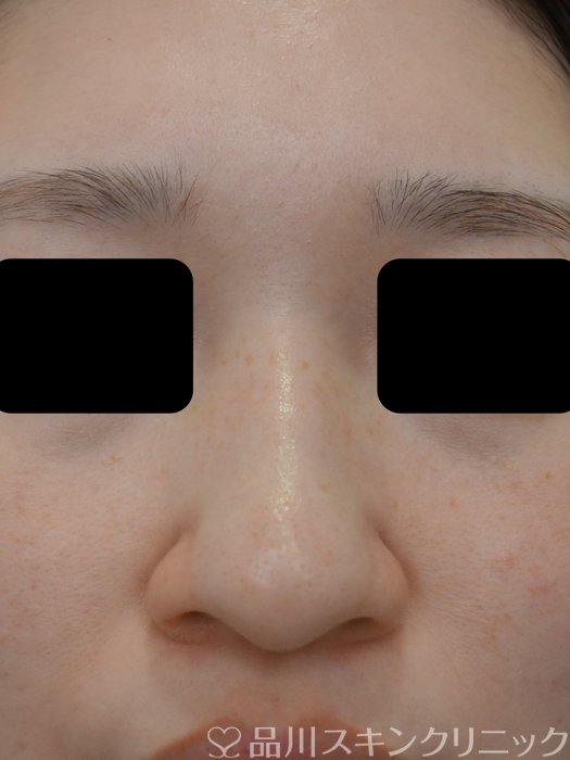 症例NO.75390のBEFORE写真