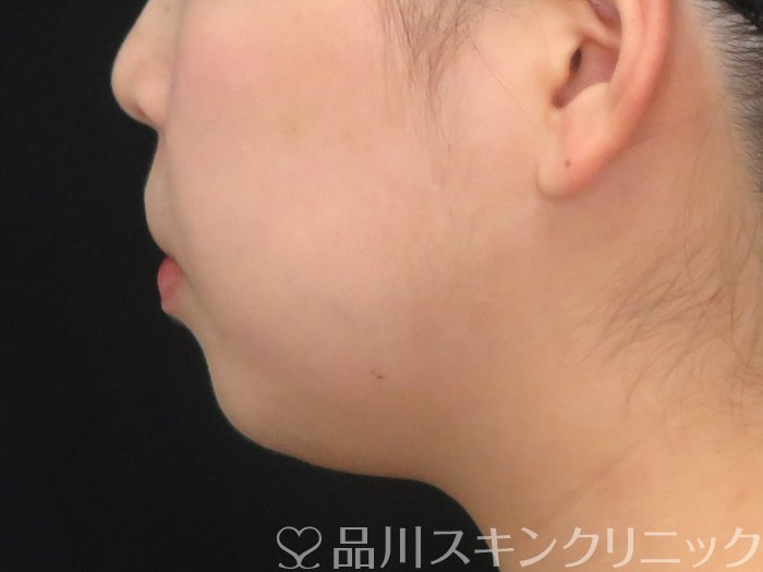 症例NO.67593のAFTER写真