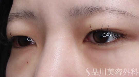 症例NO.73617のBEFORE写真