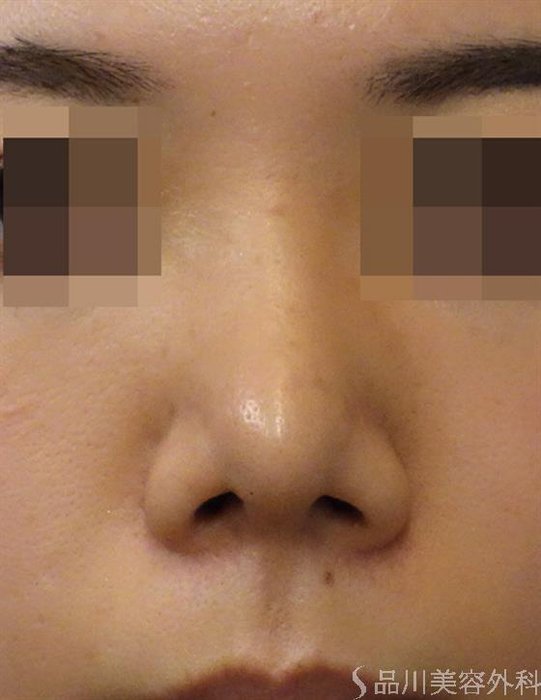症例NO.39898のAFTER写真