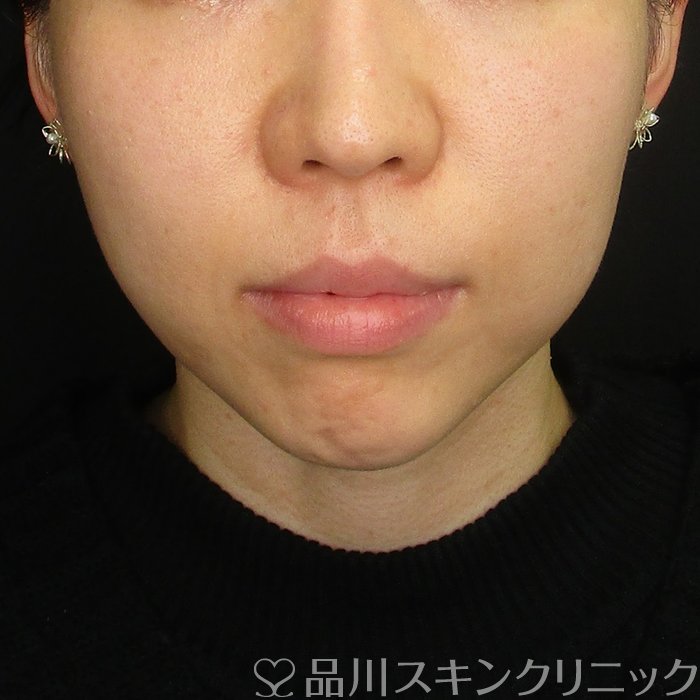 症例NO.70281のBEFORE写真