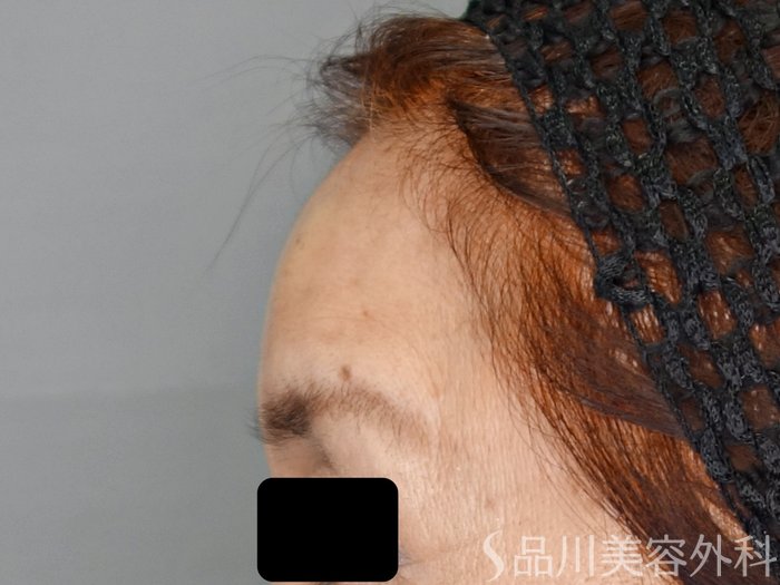 症例NO.70146のAFTER写真