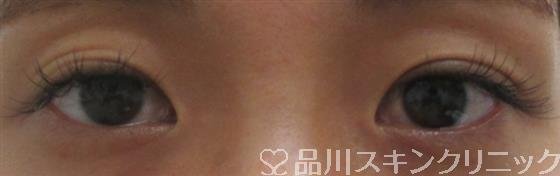 症例NO.25424のBEFORE写真