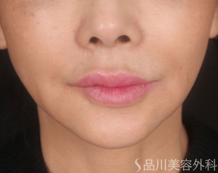 症例NO.73043のBEFORE写真