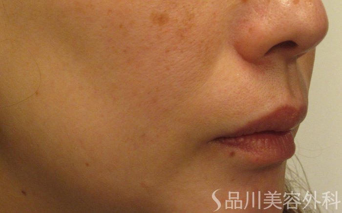 症例NO.72252のBEFORE写真