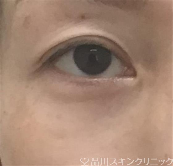 症例NO.46620のAFTER写真