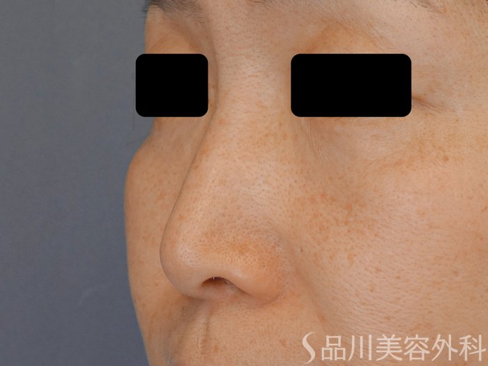 症例NO.71408のBEFORE写真