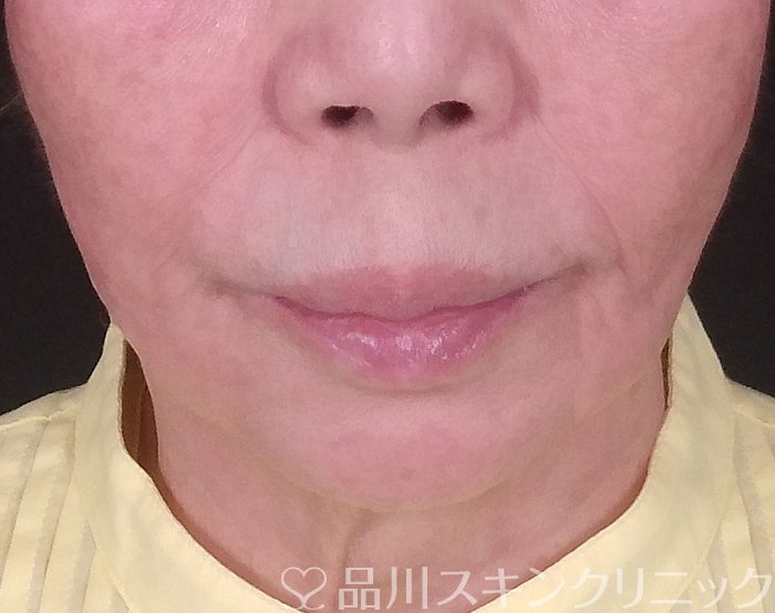 症例NO.69902のAFTER写真
