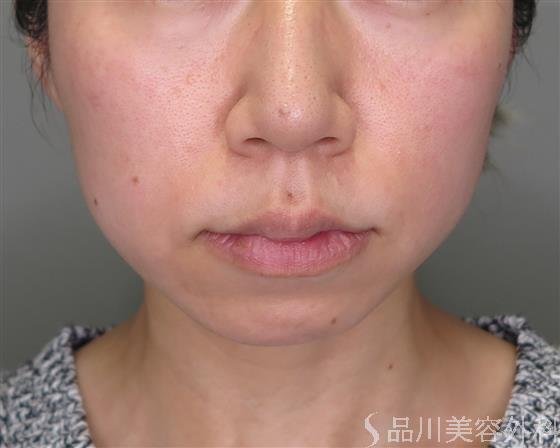 症例NO.49070のBEFORE写真
