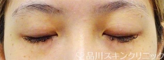 症例NO.49006のAFTER写真