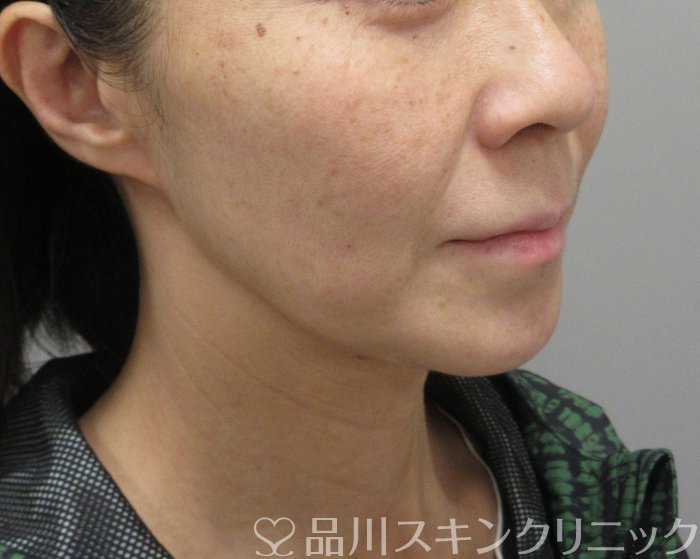 症例NO.73600のAFTER写真