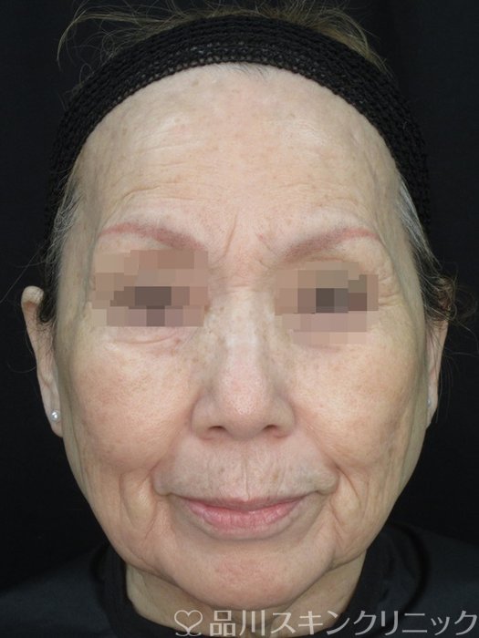 症例NO.72583のBEFORE写真