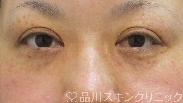 症例NO.64972のAFTER写真