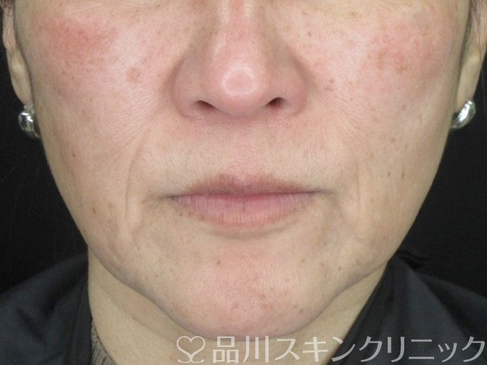 症例NO.63821のBEFORE写真