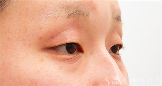 症例NO.55374のBEFORE写真