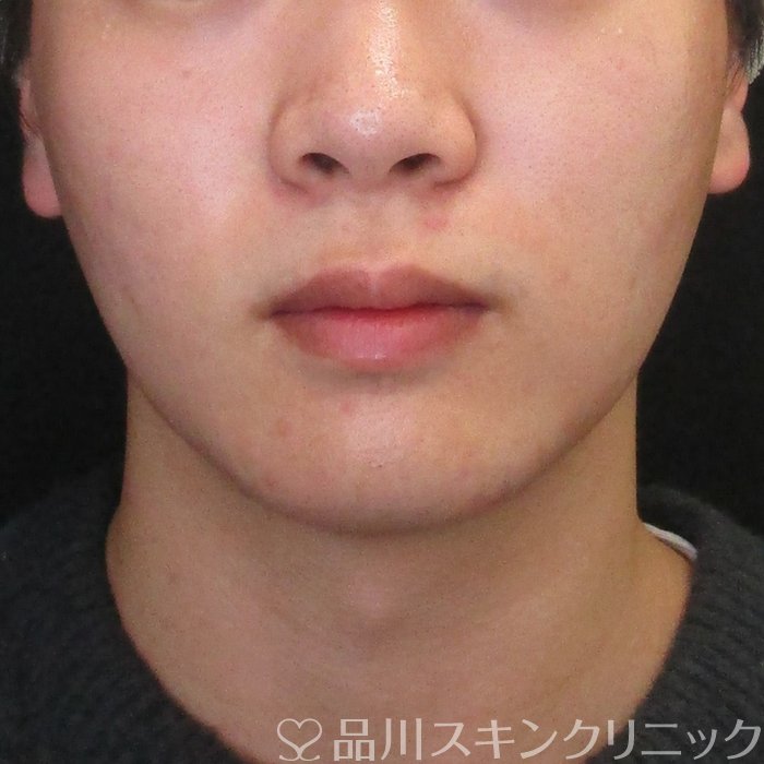 症例NO.73907のBEFORE写真