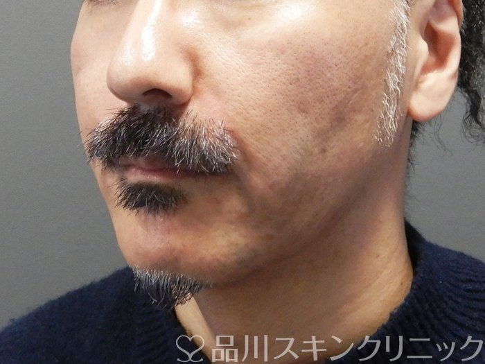 症例NO.72411のAFTER写真