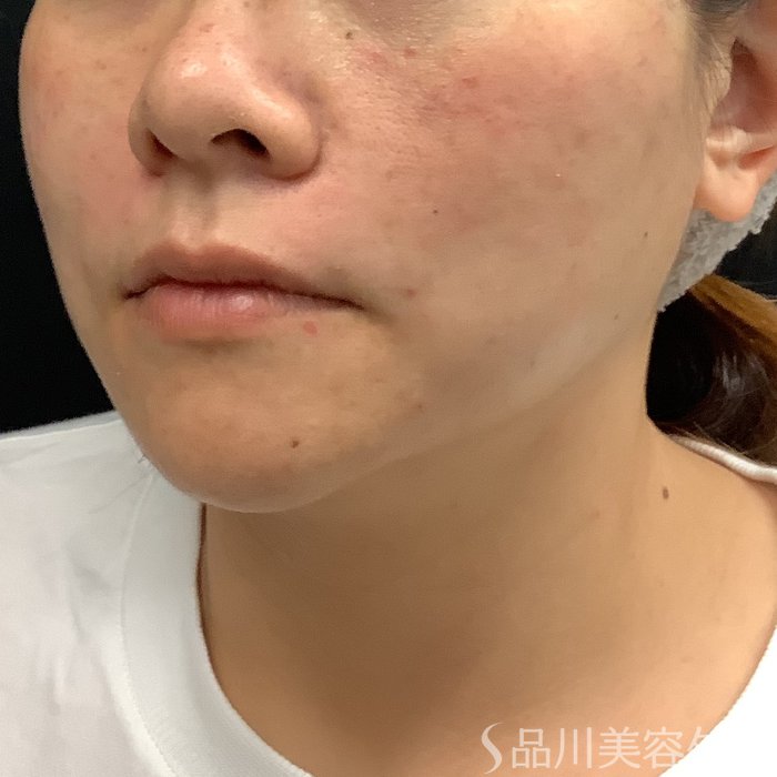 症例NO.75346のAFTER写真