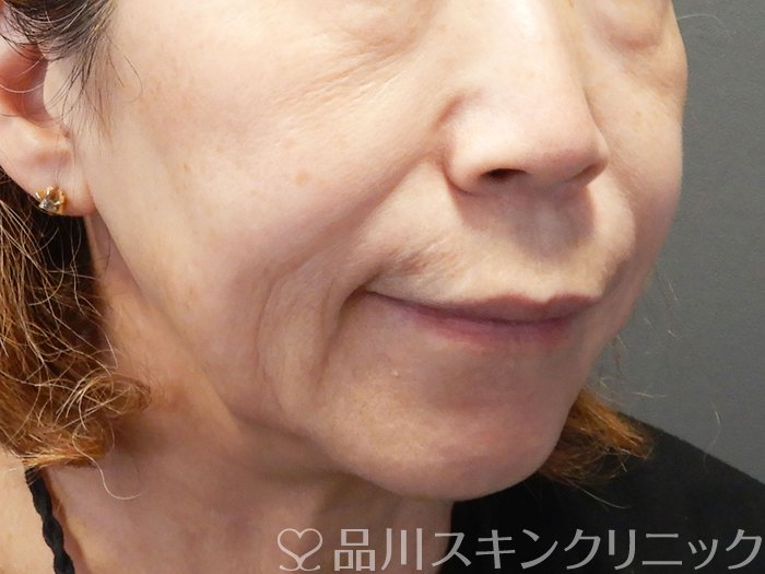 症例NO.72486のBEFORE写真