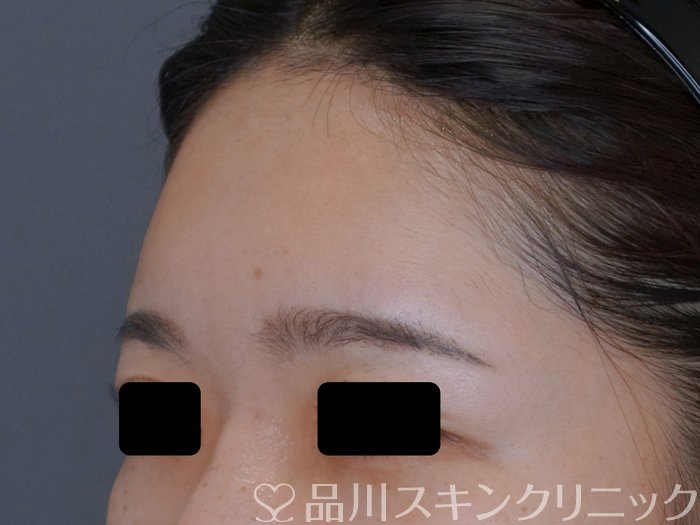 症例NO.74711のAFTER写真