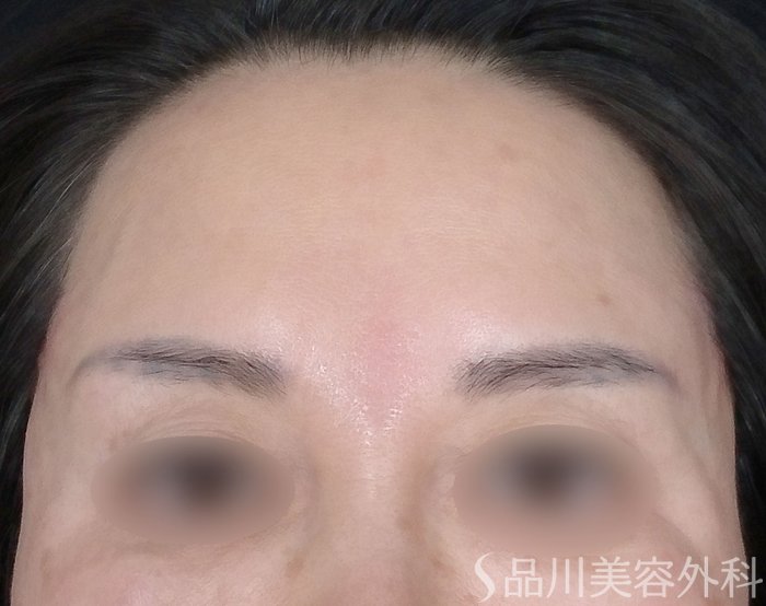 症例NO.69685のAFTER写真