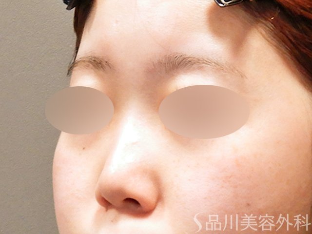 症例NO.69297のBEFORE写真