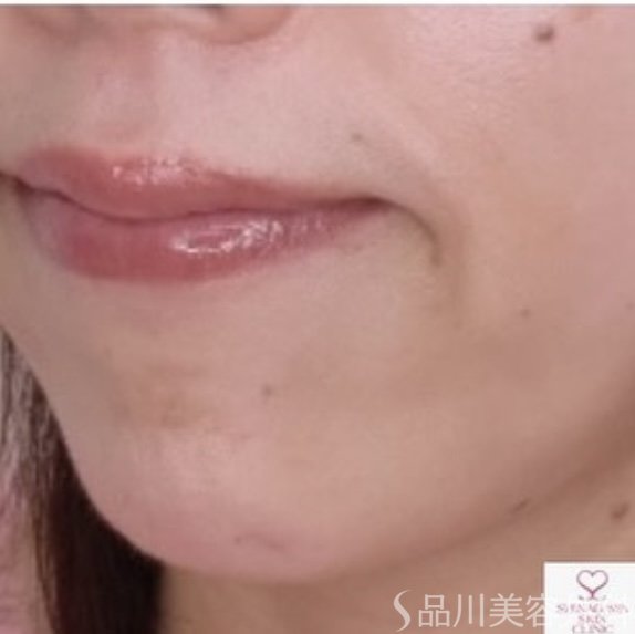 症例NO.68043のBEFORE写真