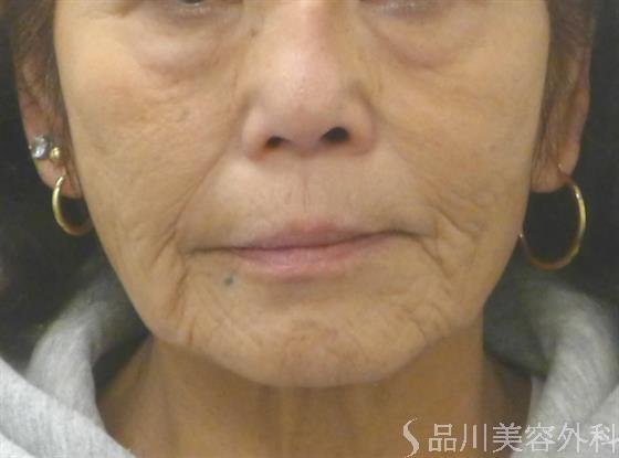 症例NO.49998のAFTER写真