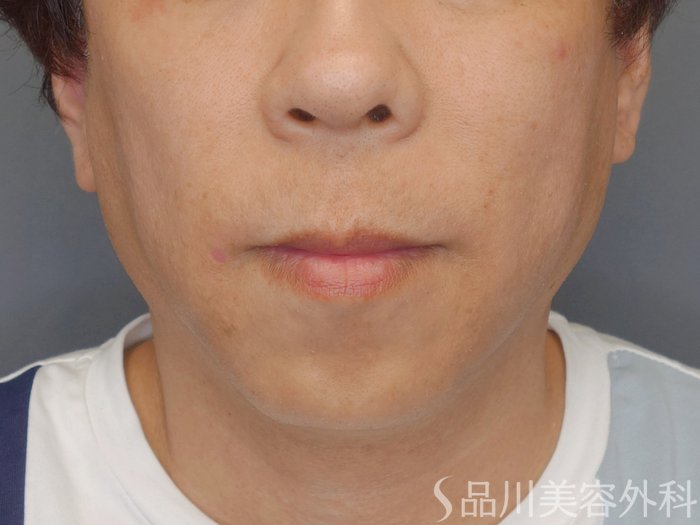 症例NO.72071のBEFORE写真