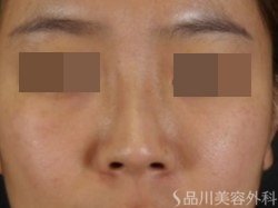 症例NO.72158のBEFORE写真