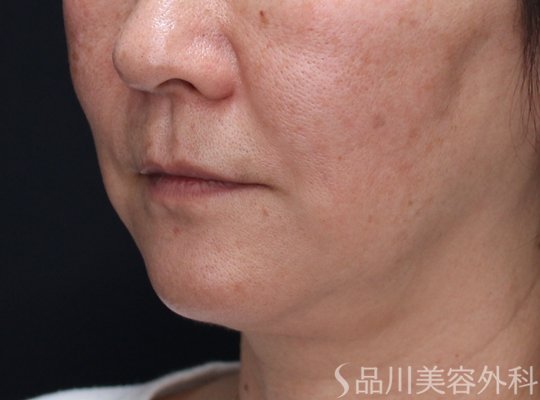 症例NO.73097のAFTER写真