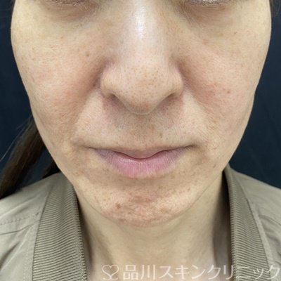 症例NO.62874のBEFORE写真