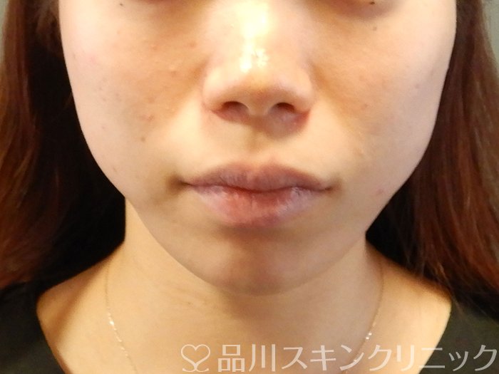 症例NO.63594のAFTER写真