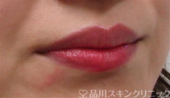 症例NO.31539のBEFORE写真