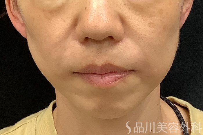 症例NO.67778のAFTER写真