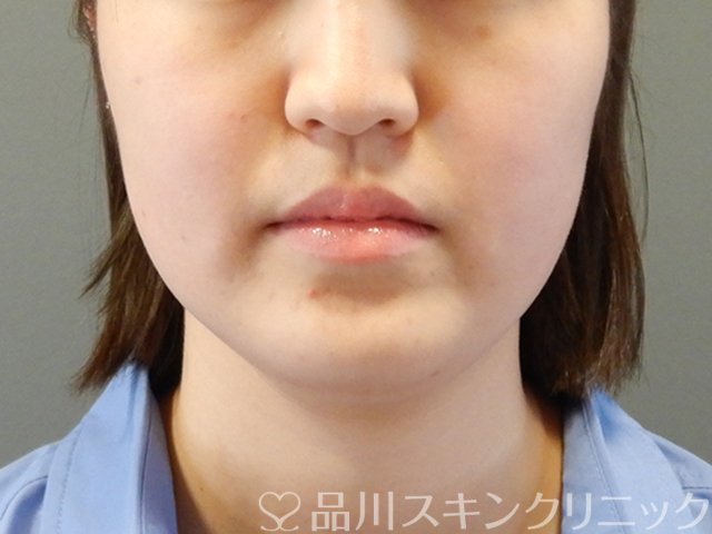 症例NO.64240のAFTER写真