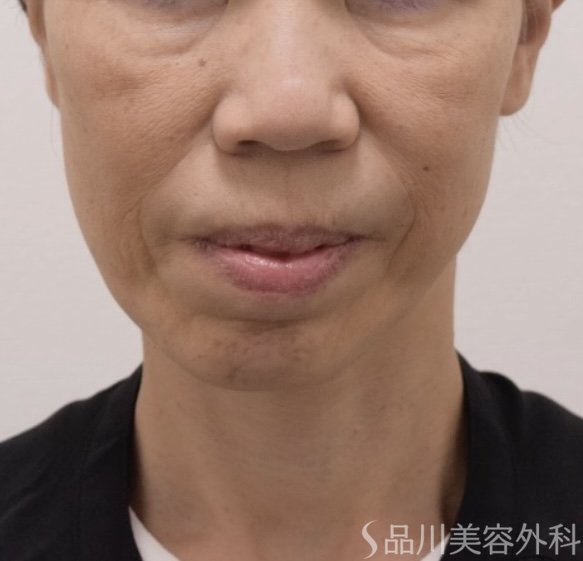 症例NO.72270のBEFORE写真