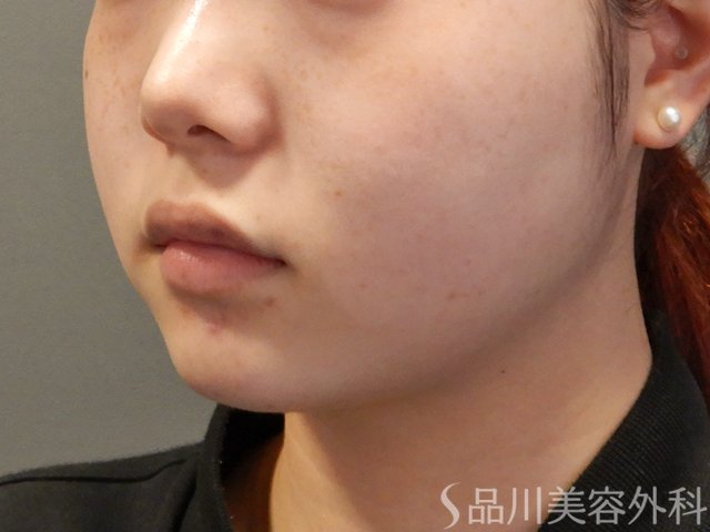 症例NO.75230のBEFORE写真