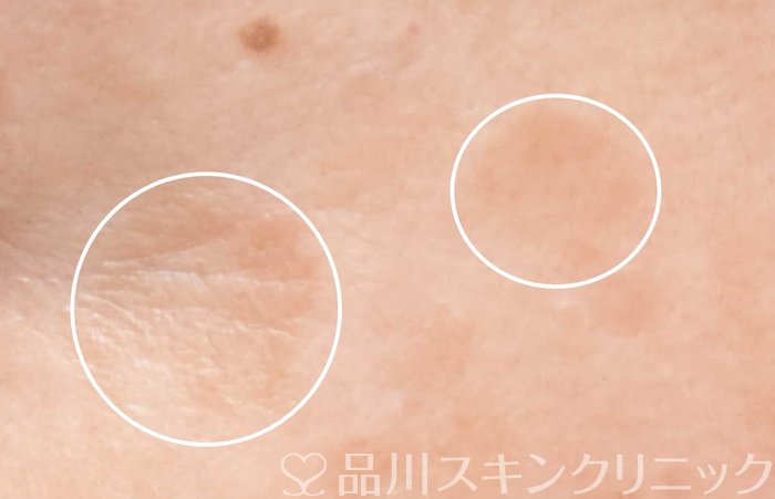 症例NO.64542のBEFORE写真