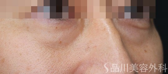 症例NO.71429のBEFORE写真