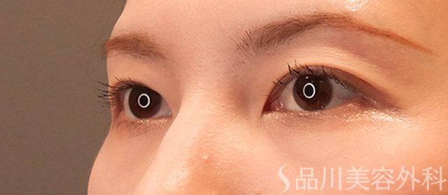 症例NO.72268のAFTER写真