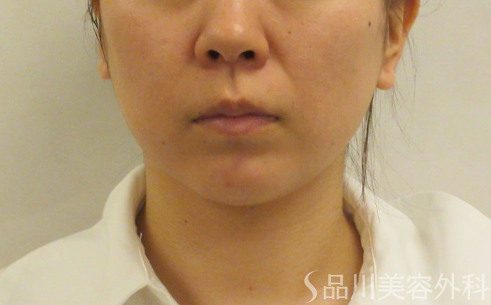 症例NO.72461のBEFORE写真