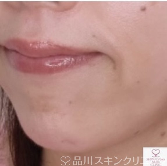 症例NO.68043のBEFORE写真